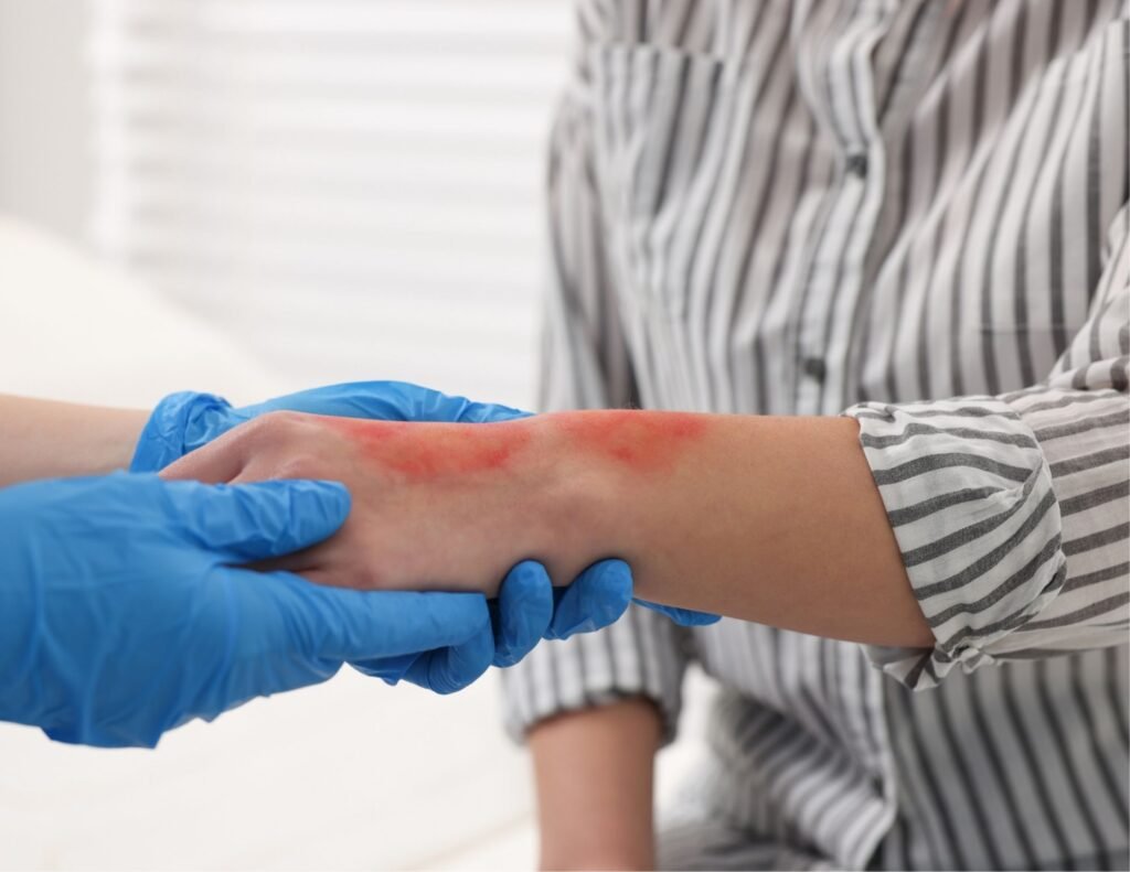 burn wound